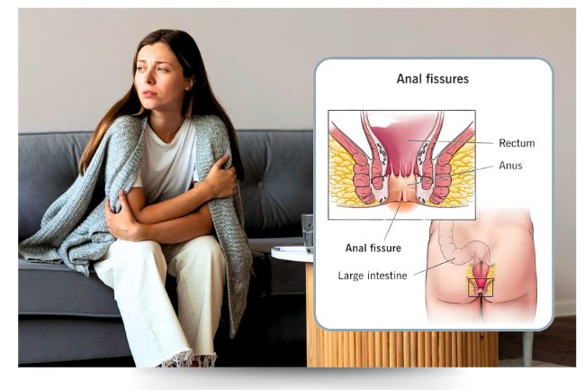 best fissure surgeon in Delhi Dr Amita Jain fissure teartment and surgery in Delhi Dr Amita Jain